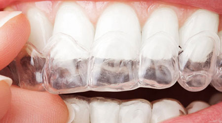 A patient putting on Invisalign aligners