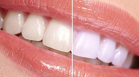 Before and after of in-office whitening