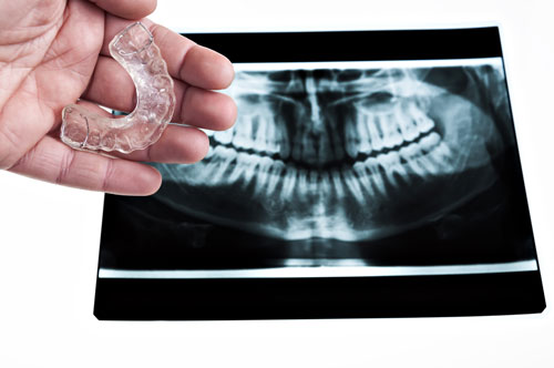 Hand holding a mouthguard to prevent teeth grinding in front of a dental x-ray
