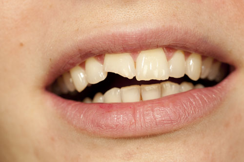 Close up of a smile with a broken front tooth