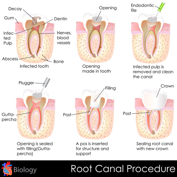 Diagrams of different stages of a root canal