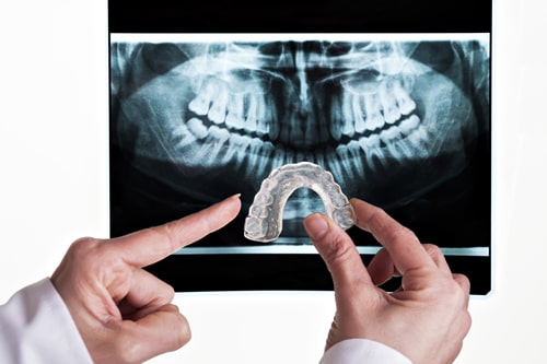 Mouth guard held up in front of a dental x-ray